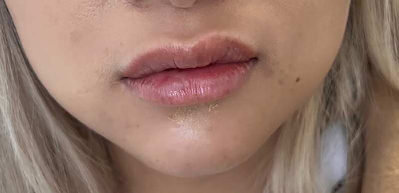 Close-up of a person's lips and chin, with visible dry skin and light blemishes—perfect for showcasing results in a Before and After Gallery Vancouver. Blonde hair is partially visible at the sides.