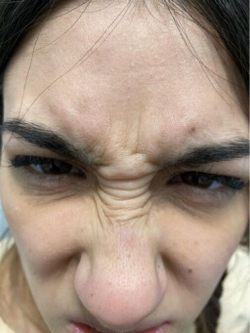 Close-up of a person's face with a furrowed brow and wrinkled forehead, suggesting they are frowning or concentrating—ideal for showcasing expressions in a Before and After Gallery Vancouver.