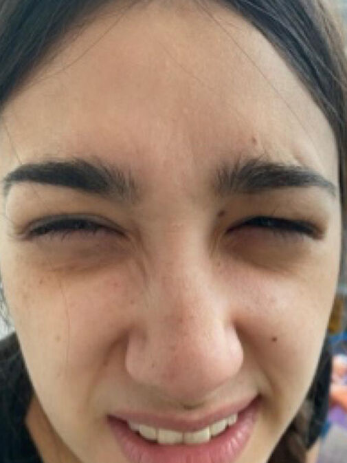 Close-up of a person squinting with their eyes nearly closed, mouth slightly open, and eyebrows furrowed, expressing curiosity often seen in the Before and After Gallery Vancouver.