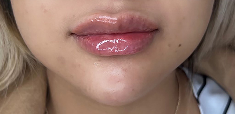 Close-up of a person's face showing glossy, swollen lips, possibly after a cosmetic procedure—an example featured in our Before and After Gallery Vancouver. The skin around the mouth appears smooth with a few small blemishes.