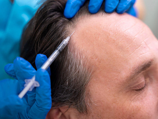 A person receives a PRP Treatment in Vancouver, with an injection in the scalp near the hairline administered by someone wearing blue gloves.