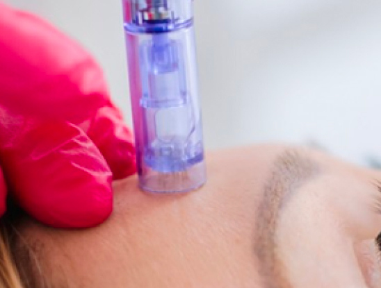 A gloved hand holds a microneedling device against a person's forehead during a cosmetic skin treatment at Medical Services Vancouver.